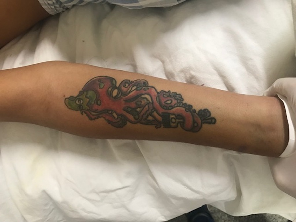 Tatuagens paciente